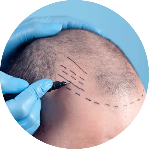 Imagem ilustrativa de transplante capilar FUE